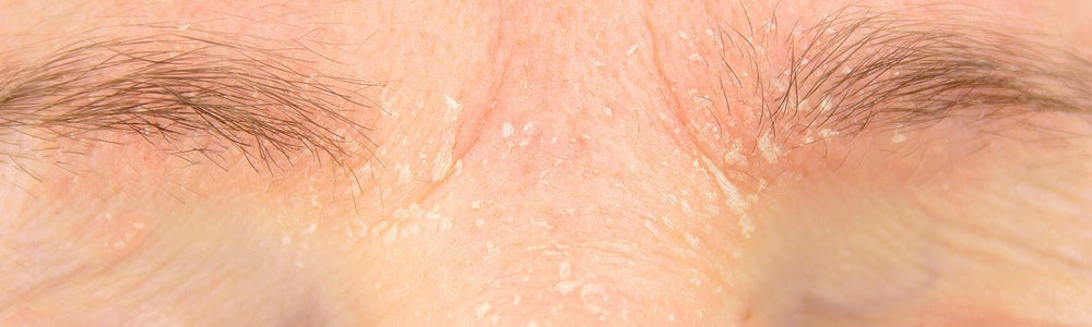 Glimmer Goddess guide to retinoid irritation, redness, and retinization.