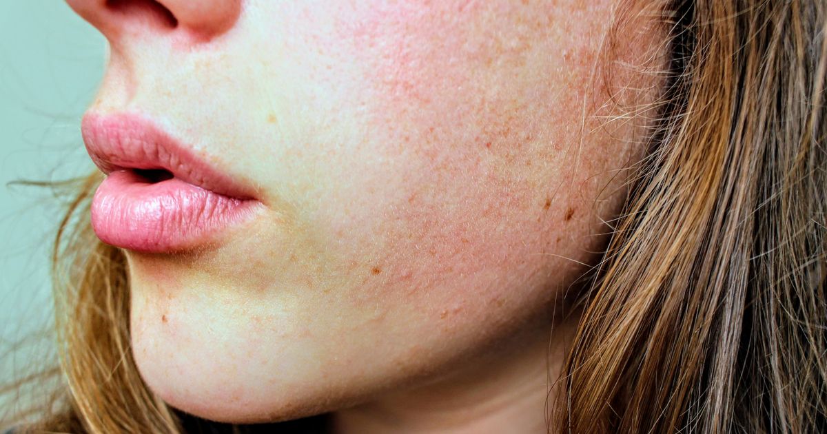 Eczema Face: Natural Care Guide & Soothing Remedies