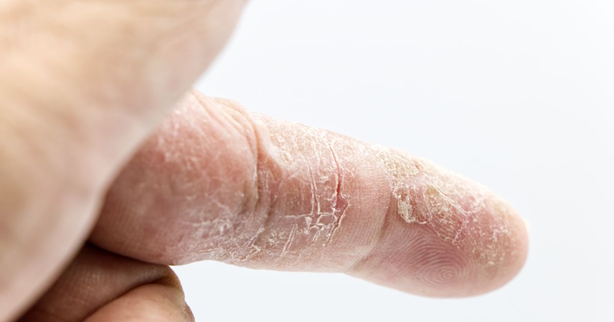 What Is Eczema? A Complete Guide to Managing Flare-Ups