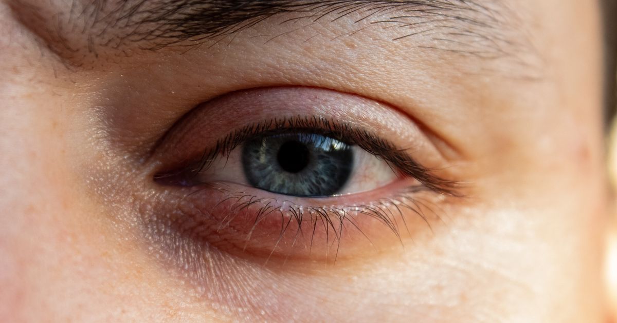 Remedies for Eczema on Eyelids: Natural Solutions That Work