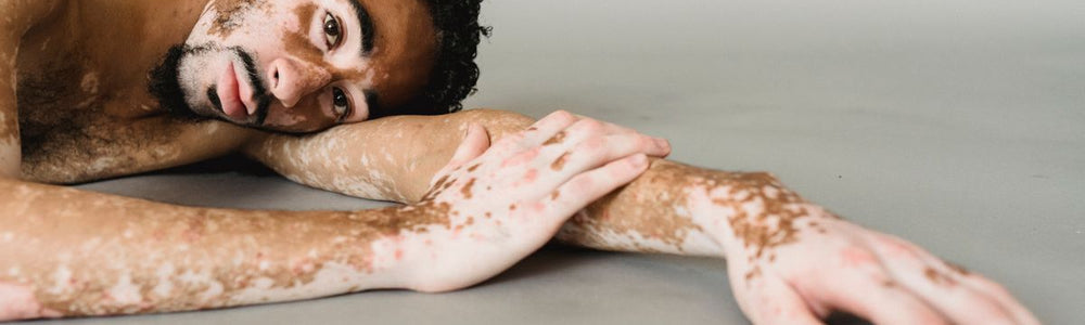 Person with irritated skin for an educational guide explaining eczema and immune-system involvement.