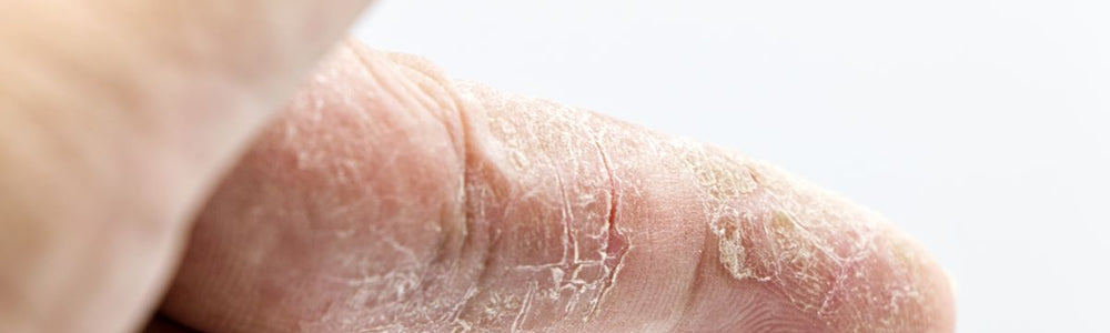Eczema education guide covering symptoms, flare-ups, gentle skin care, and when to seek medical care.