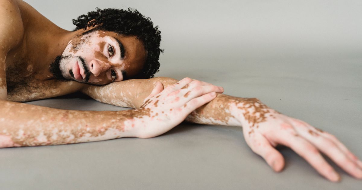 Is Eczema Autoimmune? What Science Actually Shows