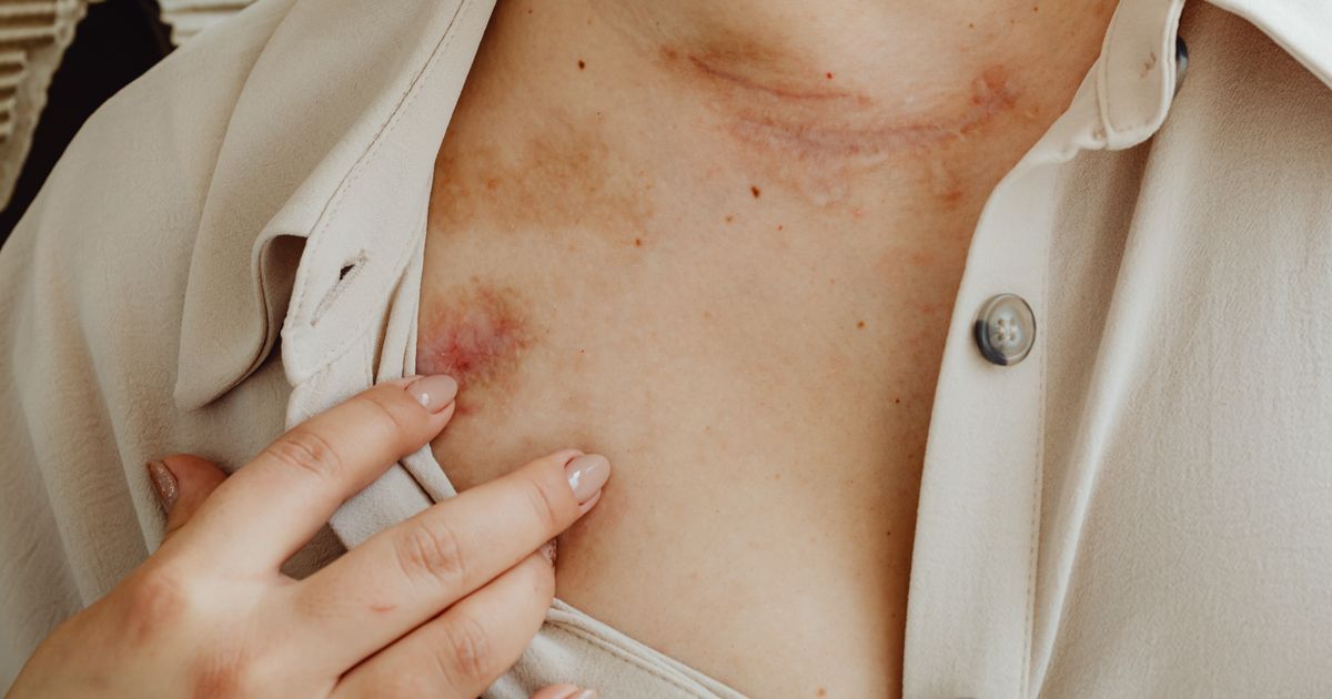 Ringworm or Eczema? How to Tell the Difference & Treat Right
