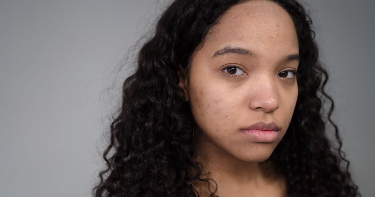 Acne scars and dark spots skincare guide