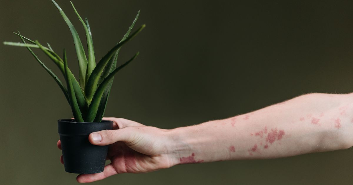 Best Skincare for Psoriasis or Eczema: Natural Solutions
